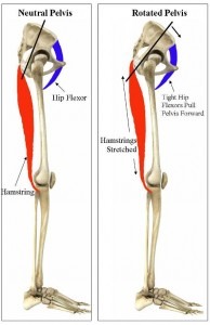 rotated-pelvis-194x300